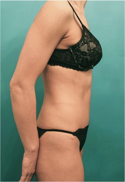 Abdominoplasty/ Tummy Tuck Patient #1 After Photo # 10