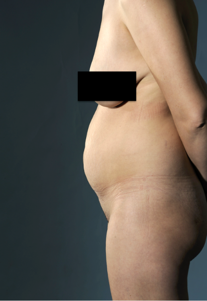Abdominoplasty/ Tummy Tuck Patient #1 Before Photo # 7