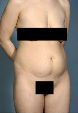 Abdominoplasty/ Tummy Tuck Patient #1 Before Photo Thumbnail # 3