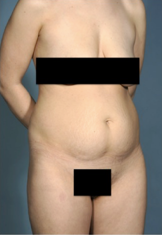 Abdominoplasty/ Tummy Tuck Patient #1 Before Photo # 3