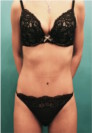 Abdominoplasty/ Tummy Tuck Patient #1 After Photo Thumbnail # 2