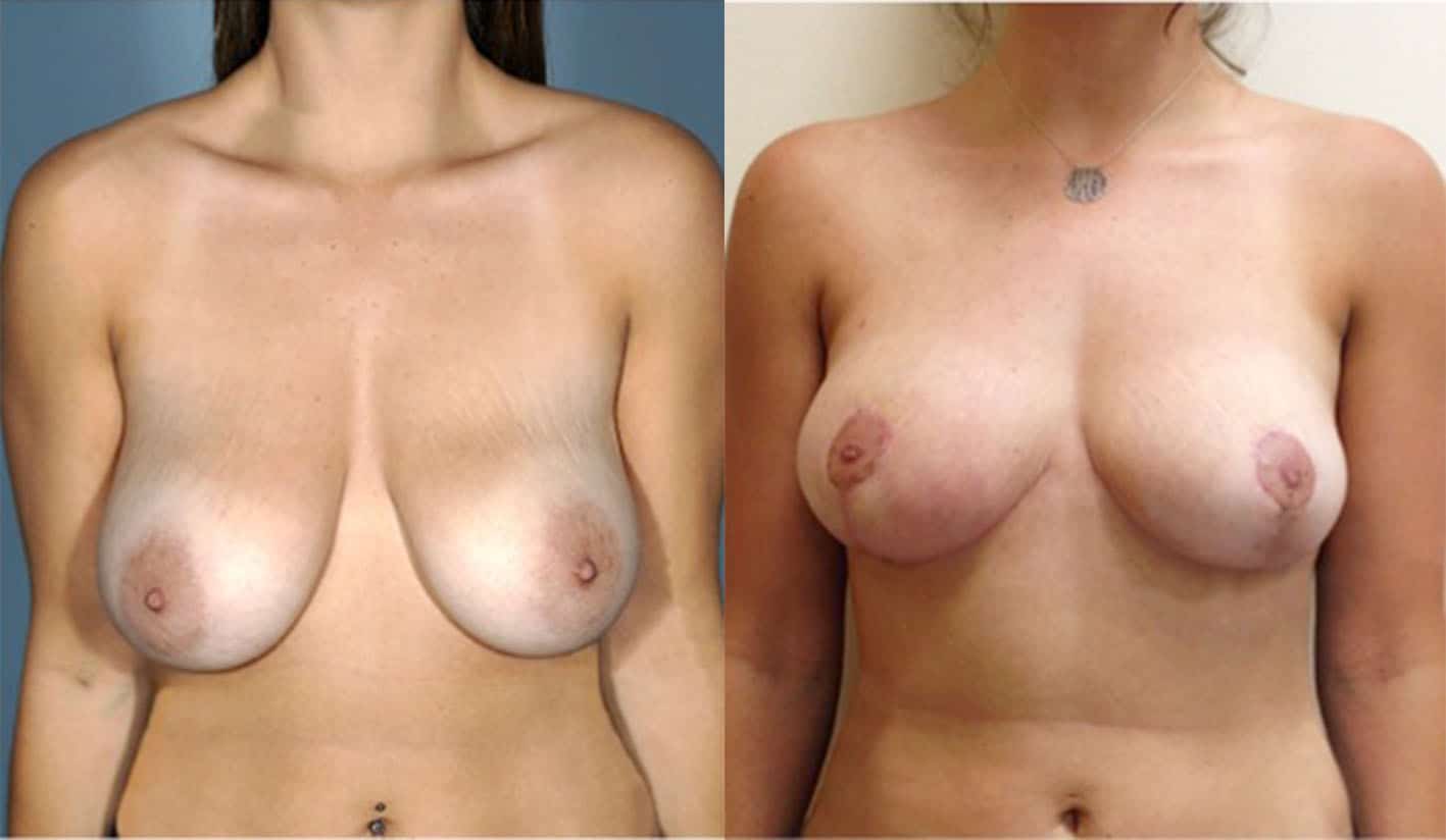 Breast Reduction NYC