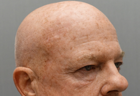 After Image: Laser Resurfacing Patient #3 -