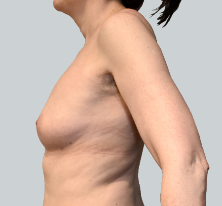 Breast Augmentation (Fat) Patient #4 After Photo # 6