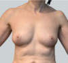 Breast Augmentation (Fat) Patient #4 After Photo Thumbnail # 2