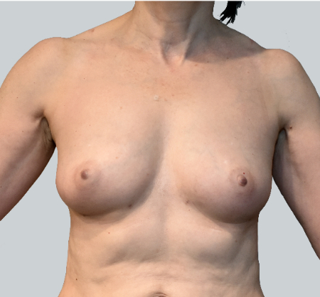 Breast Augmentation (Fat) Patient #4 After Photo # 2