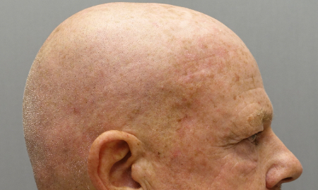 Male Laser Resurfacing Patient #2 Before Photo # 7
