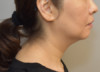 Kybella Patient #19 Before Photo Thumbnail # 5