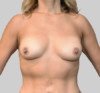 Breast Augmentation (Fat) Patient #3 After Photo Thumbnail # 2