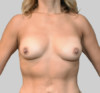 Breast Augmentation (Fat) Patient