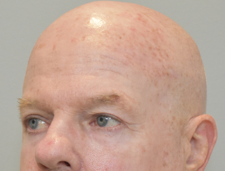 Male Laser Resurfacing Patient #2 After Photo # 4