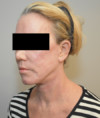 Laser Resurfacing Patient #4 After Photo Thumbnail # 6