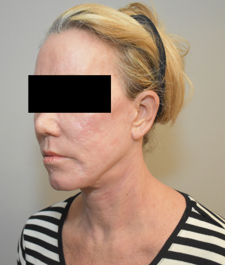 After Image: Laser Resurfacing Patient #4 -
