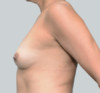 Breast Augmentation (Fat) Patient #3 Before Photo Thumbnail # 5