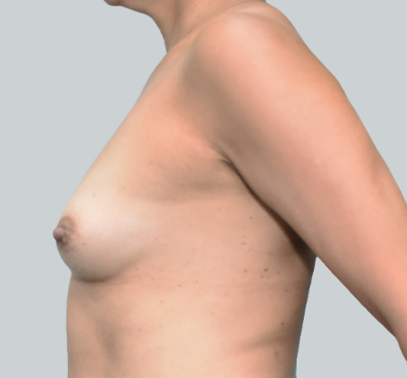 Breast Augmentation (Fat) Patient #3 Before Photo # 5