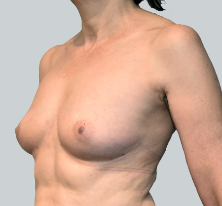Breast Augmentation (Fat) Patient #4 After Photo # 4