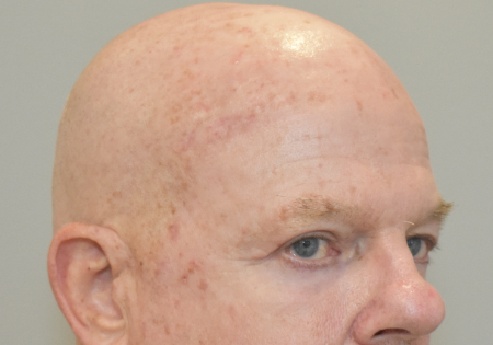 Before Image: Laser Resurfacing Patient #3 -