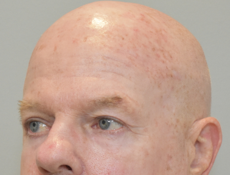 After Image: Laser Resurfacing Patient #3 -