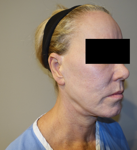 Before Image: Laser Resurfacing Patient #4 -