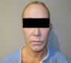 Laser Resurfacing Patient