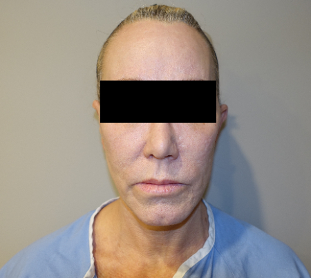 Before Image: Laser Resurfacing Patient #4 - 