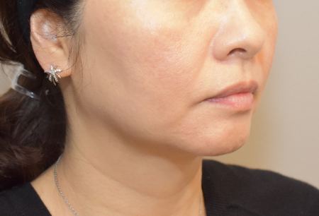 After Image: Jowl/Jawline Contouring Kybella Patient #12 -