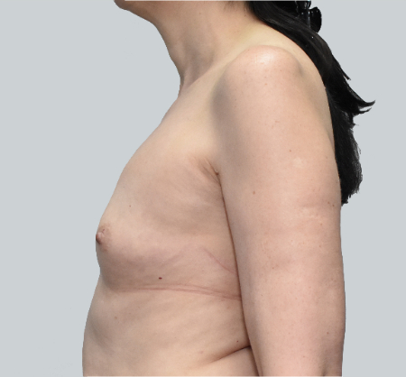 Breast Augmentation (Fat) Patient #4 Before Photo # 5