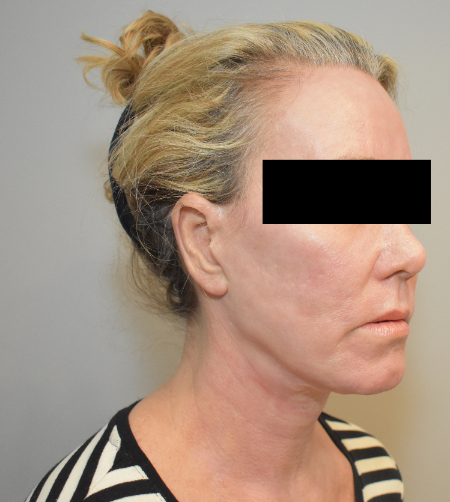 After Image: Laser Resurfacing Patient #4 -