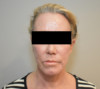 Laser Resurfacing Patient