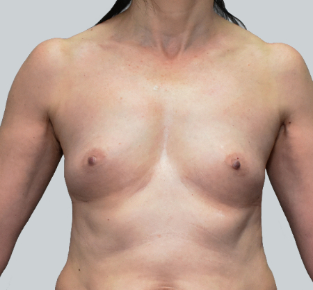 Breast Augmentation (Fat) Patient #4 Before Photo # 1