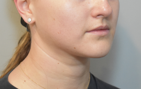 Liposuction Patient #28 After Photo # 4