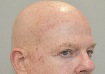 Male Laser Resurfacing Patient #2 After Photo # 6