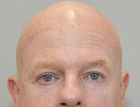After Image: Laser Resurfacing Patient #3 - 