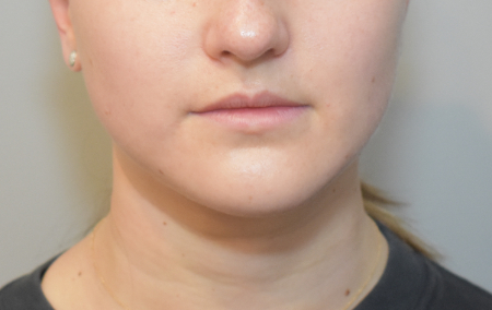 Liposuction Patient #28 After Photo # 2