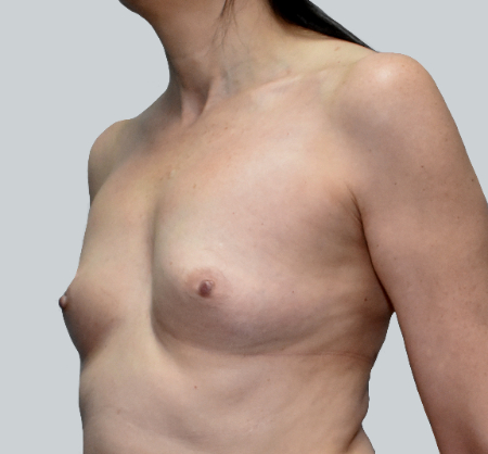 Breast Augmentation (Fat) Patient #4 Before Photo # 3