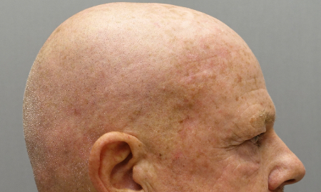 After Image: Laser Resurfacing Patient #3 -