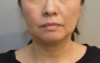 Jowl/Jawline Contouring Kybella Patient #12 Before Photo Thumbnail # 1
