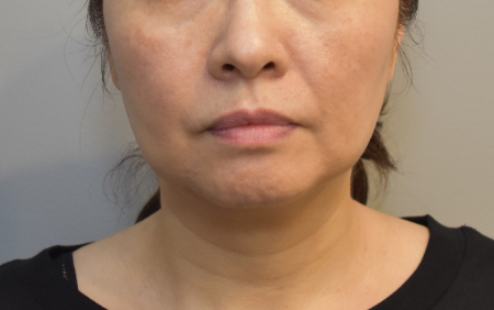 Before Image: Jowl/Jawline Contouring Kybella Patient #12 - 