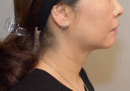 After Image: Jowl/Jawline Contouring Kybella Patient #12 -