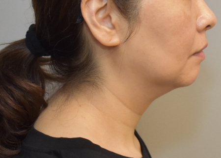 Before Image: Jowl/Jawline Contouring Kybella Patient #12 -