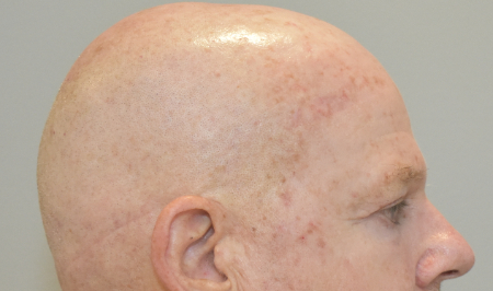 Before Image: Laser Resurfacing Patient #3 -