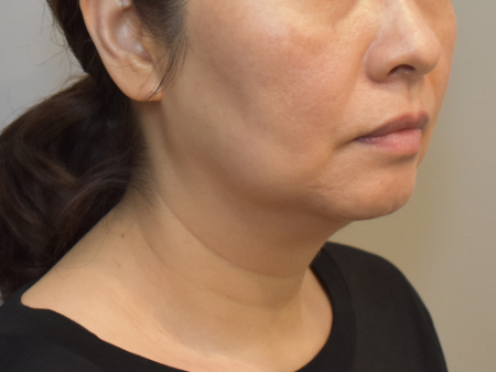Before Image: Jowl/Jawline Contouring Kybella Patient #12 -