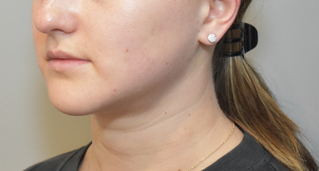 Liposuction Patient #28 After Photo # 6