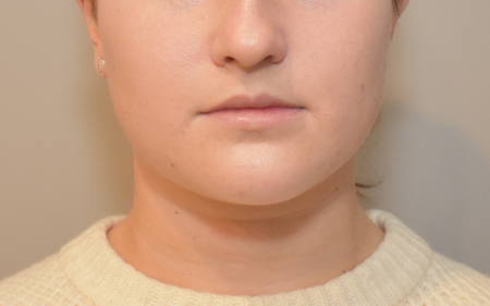 Liposuction Patient #28 Before Photo # 1