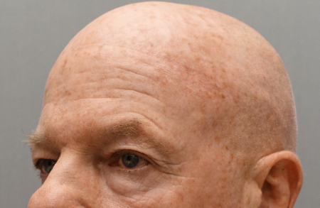 Before Image: Laser Resurfacing Patient #3 -