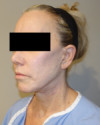 Laser Resurfacing Patient #4 Before Photo Thumbnail # 5