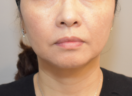 After Image: Jowl/Jawline Contouring Kybella Patient #12 - 