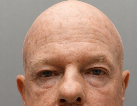 Before Image: Laser Resurfacing Patient #3 - 
