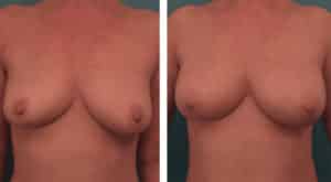 Breast Fat Transfer | NYC