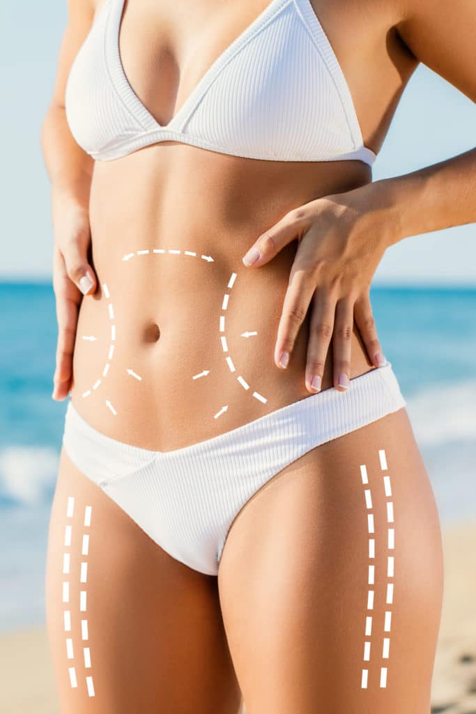 Close up detail of slim attractive female torso in white bikini outdoors. Conceptual dotted surgical incision lines marked on skin for body contouring. Girl touching hips with hands. 